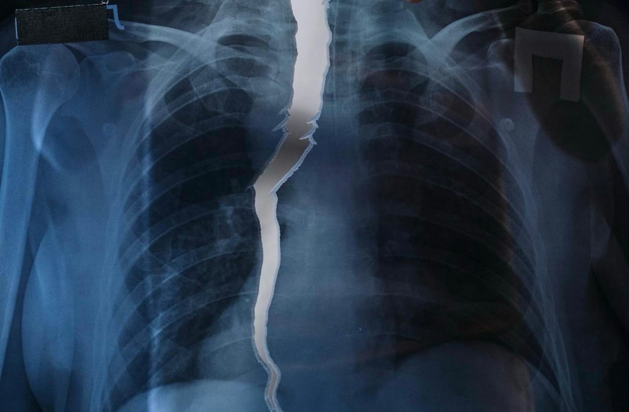 Radiografía rota